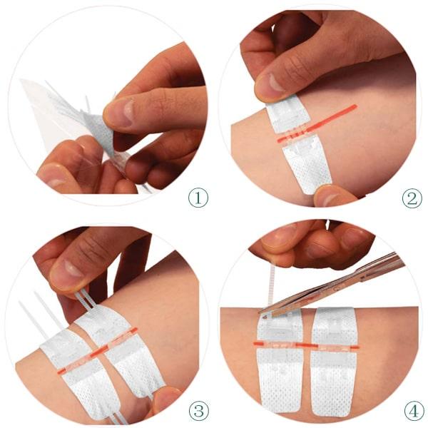 Zipper Wound Closure Bandage – No-Stitch Skin Repair Patch | Fast, Painless Healing